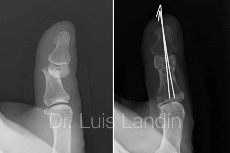 fractura de dedo en radiografia medica